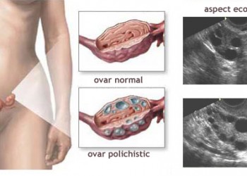 încercând să piardă în greutate cu ovare polichistice