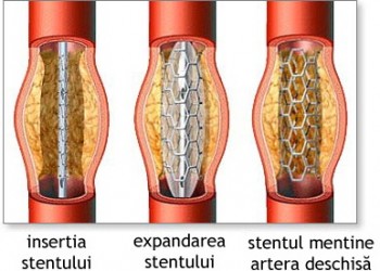 erecție după altoire bypass coronarian produse pentru o erecție mai bună