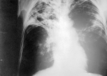 Tuberculoza - simptome, investigatii, metode de tratament