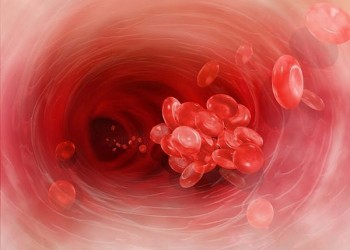 cum să evitați formarea de cheaguri de sânge în varicoză