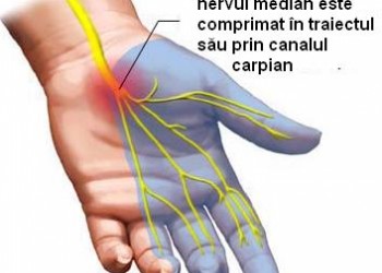 sindrom de canal carpian bilateral)