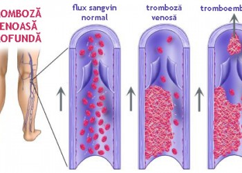 varicoza i tromboza în ceea ce diferena funcionarea în vene varicoase ale extremitailor inferioare