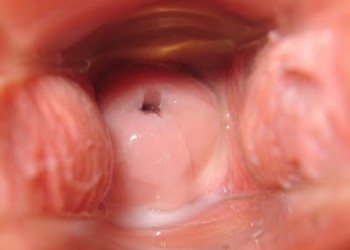 vedere încețoșată cu colul uterin