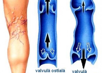 funcionarea în complicaiile dimensiunii varicoase