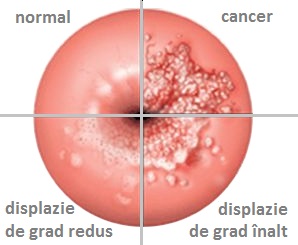 displazie și condiloame ale colului uterin