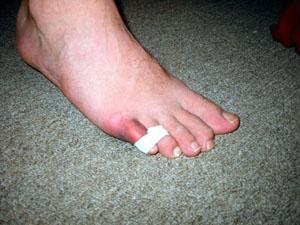 Articulație dureroasă a degetului mic de pe picior