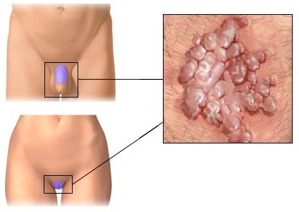 condilom la intrarea vaginului papilloma per l uomo