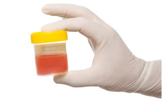 Ceea ce este sangele in urina?