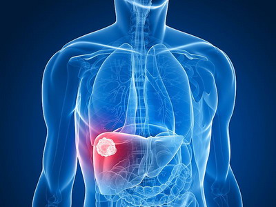 Scorul ALBI pentru evaluarea funcției hepatice la pacienții cu hepatocarcinom Scorul ALBI pentru evaluarea funcției hepatice la pacienții cu hepatocarcinom