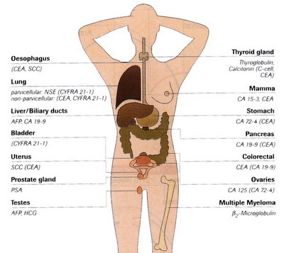 markeri tumorali pentru prostata)
